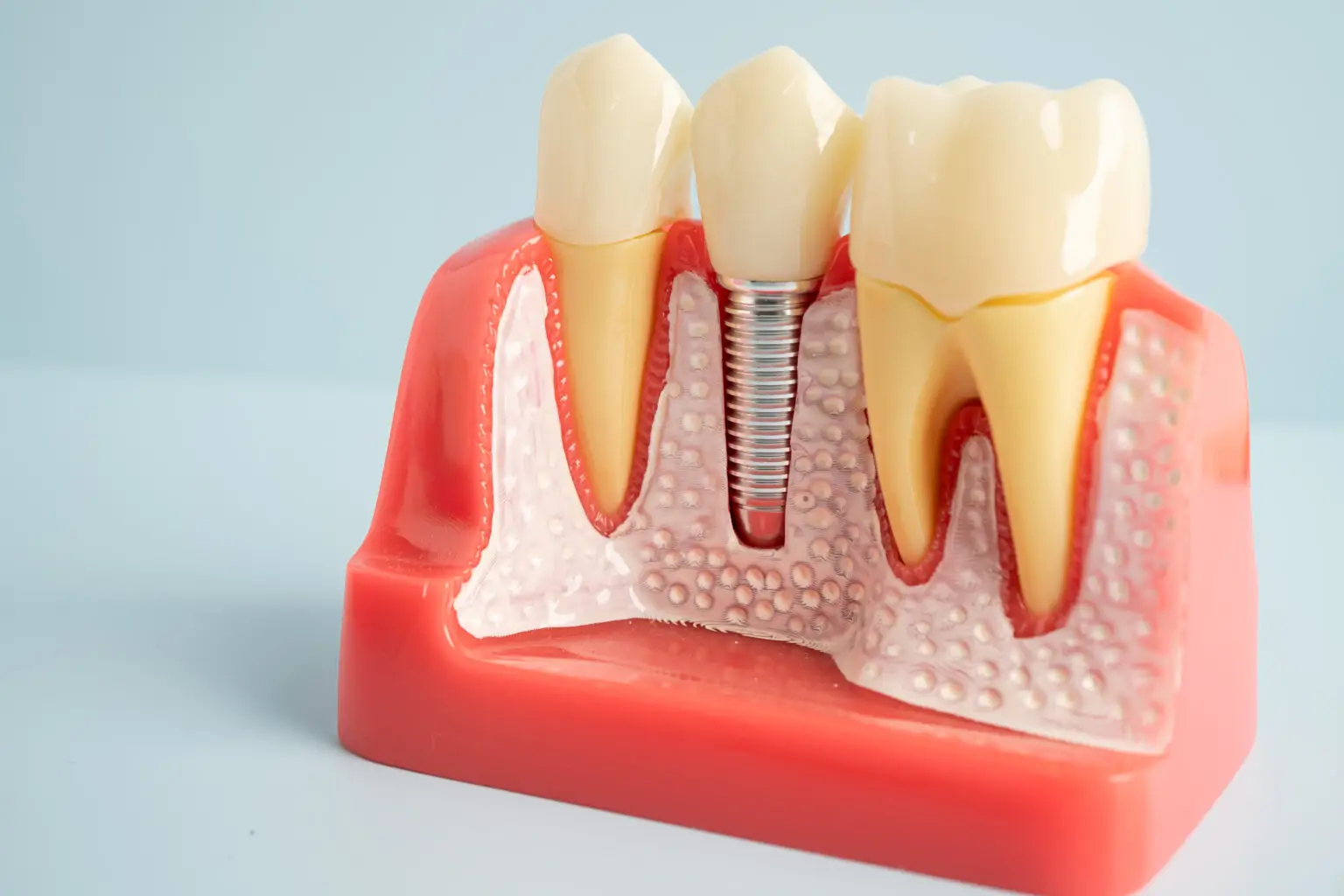 Zobni implantat kot trajna rešitev za manjkajoči zob